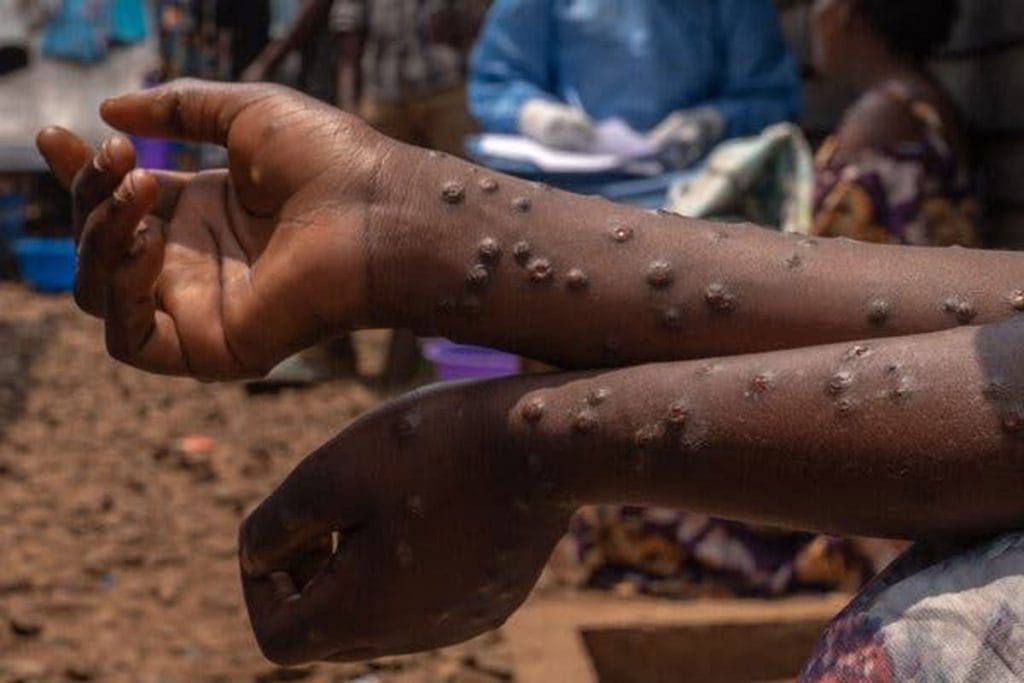 mpox patient moh zambia